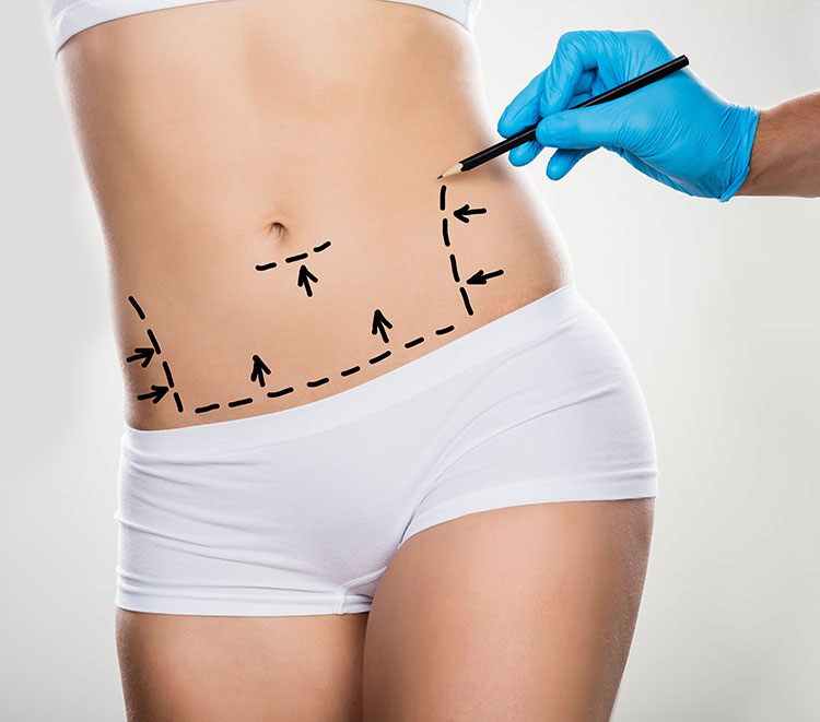 Abdominoplastie Tunisie