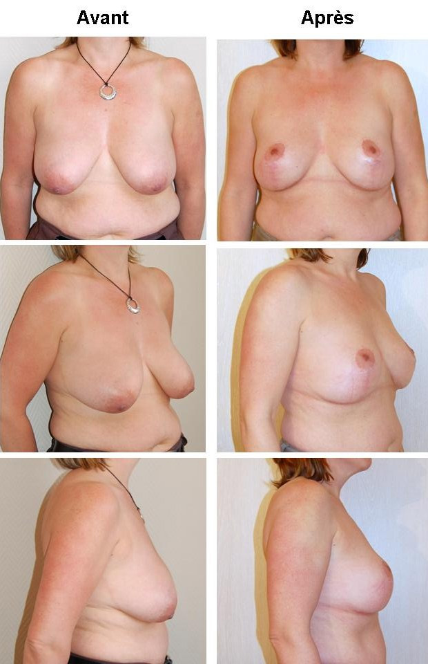 lifting seins tunisie photos avant apres