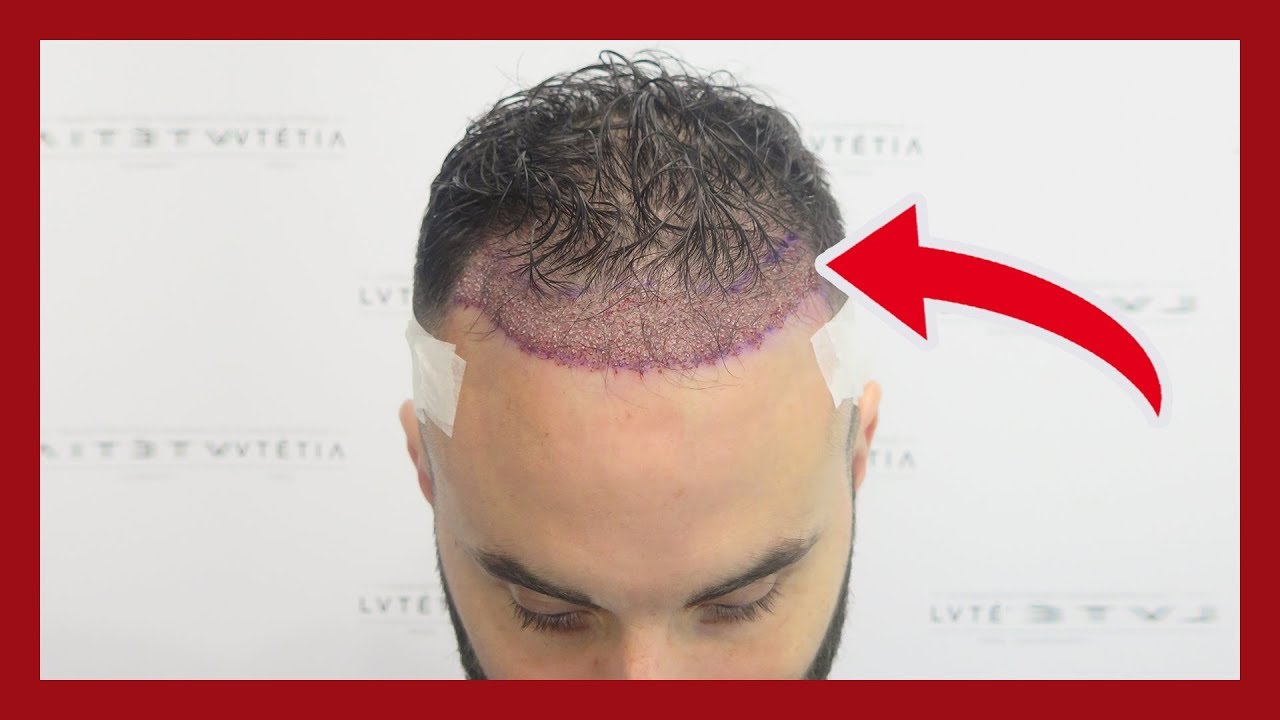 Greffe Cheveux Tunisie Prix Fue Tunisie Traitement Calvitie Tunisie Greffe Cheveux Tunisie Prix Fue Tunisie Traitement Calvitie Tunisie