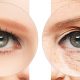 blepharoplastie-medicale-ou-chirurgicale