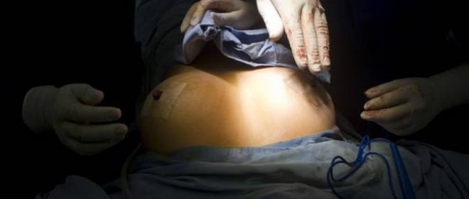 Hypotrophie mammaire Tunisie