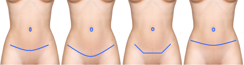 cicatrices-abdominoplastie