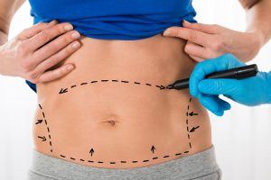 ABDOMINOPLASTIE OU LIPOSUCCION