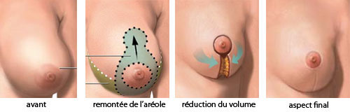 chirurgie ptose mammaire tunisie
