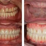 implant dentaire tunisie avant apres