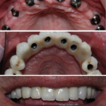 implant dentaire tunisie avant apres