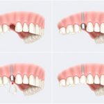 implantologie dentaire Tunisie
