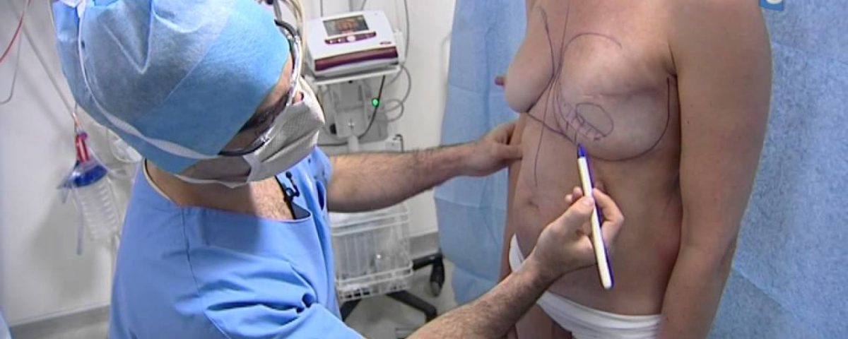 reconstruction mammaire apres ablation poitrine