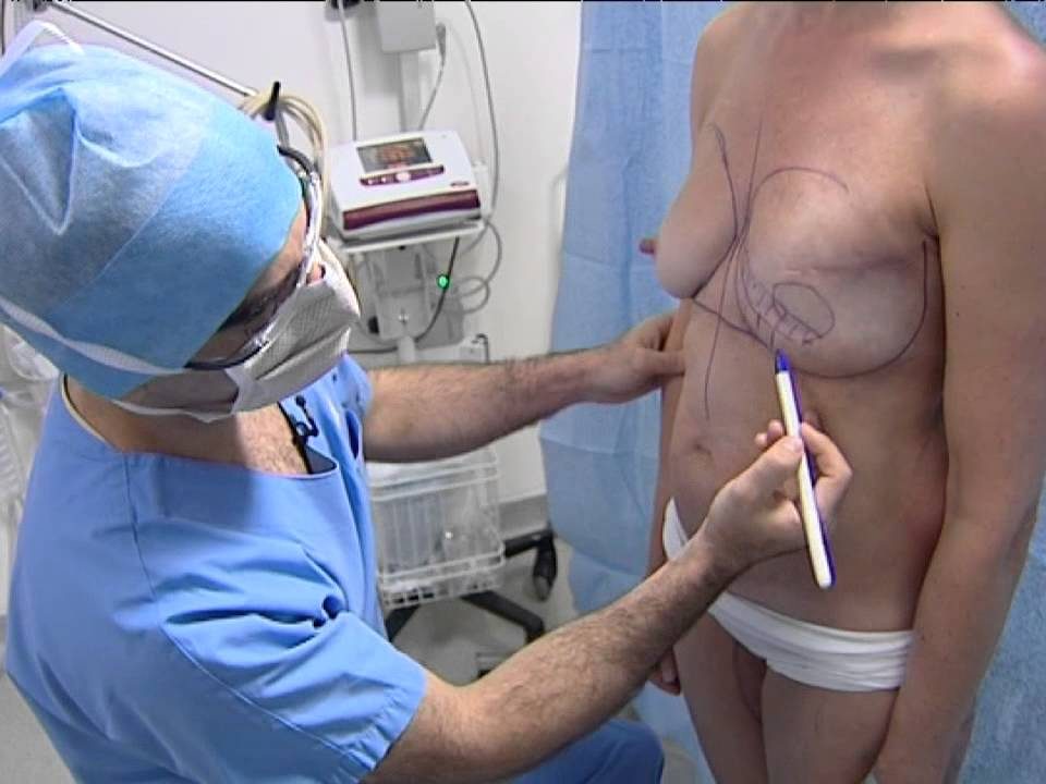 reconstruction mammaire apres ablation poitrine