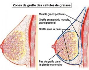 zones injection graisses seins