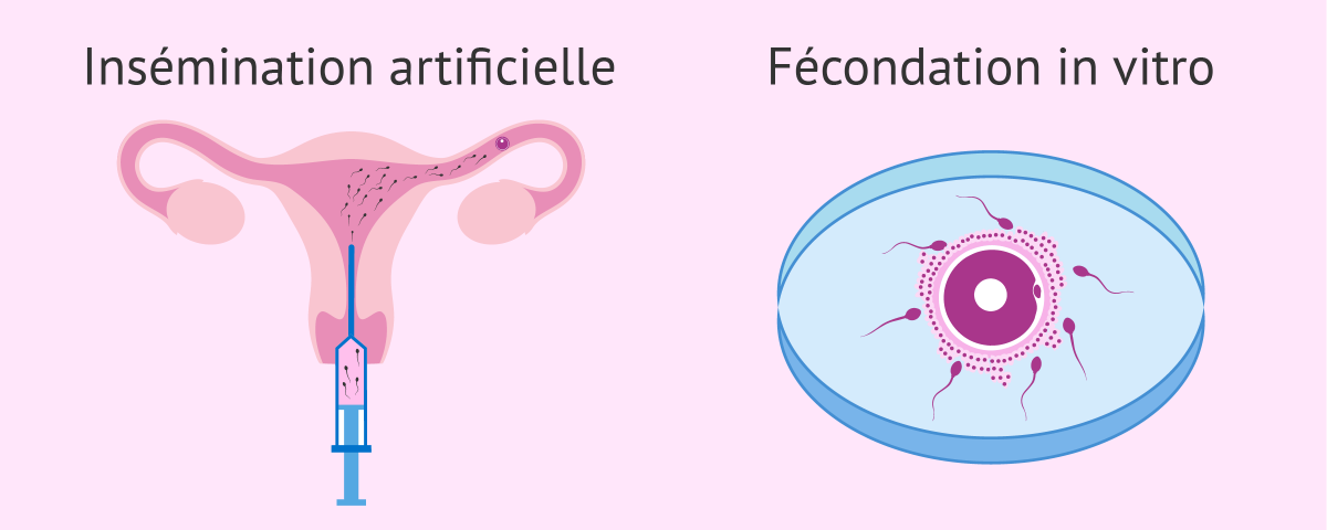 insémination artificielle et une FIV