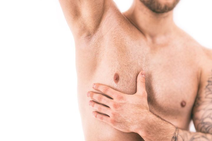 gynecomastie