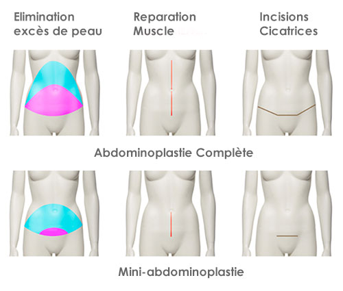 mini abdominoplastie tunisie