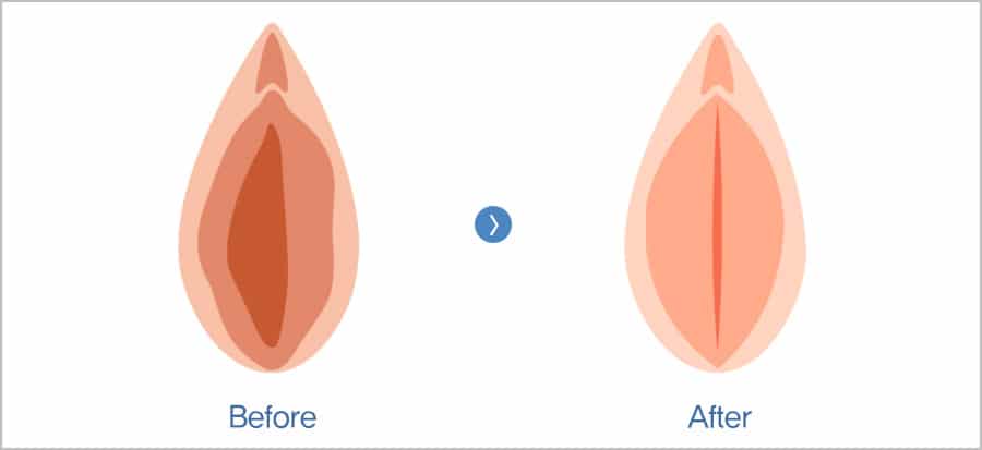 vaginoplastie