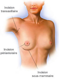 cicatrice-prothese-augmentation-mammaire-aisselle-areole-incision