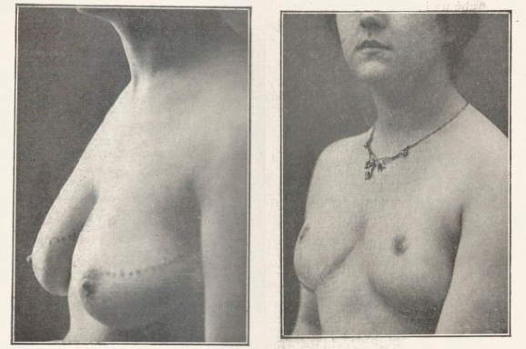 histoire chirurgie mammaire