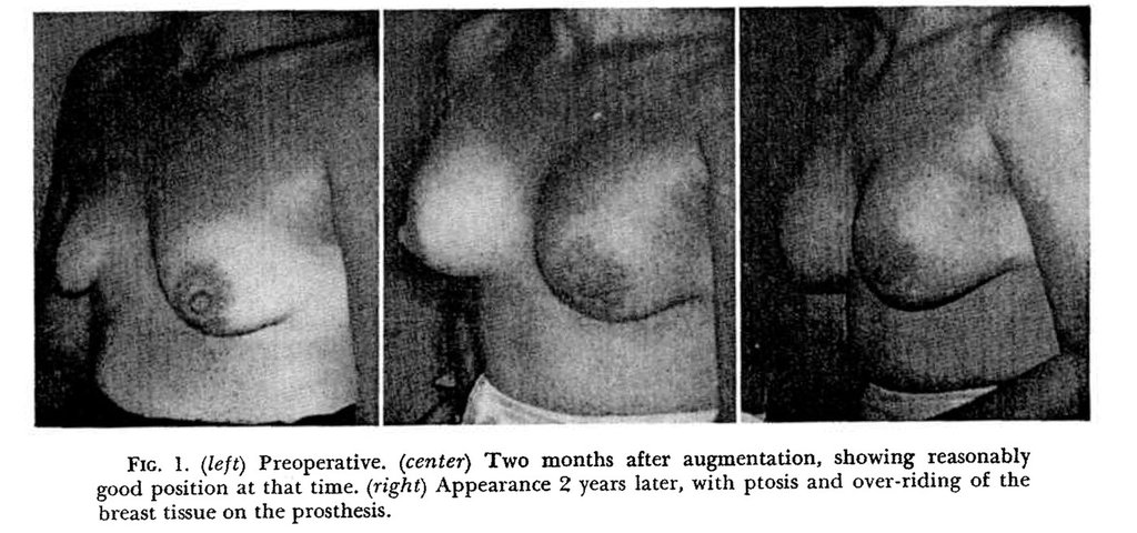 histoire implant mammaire