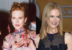 Nicole Kidman chirurgie esthetique avant apres