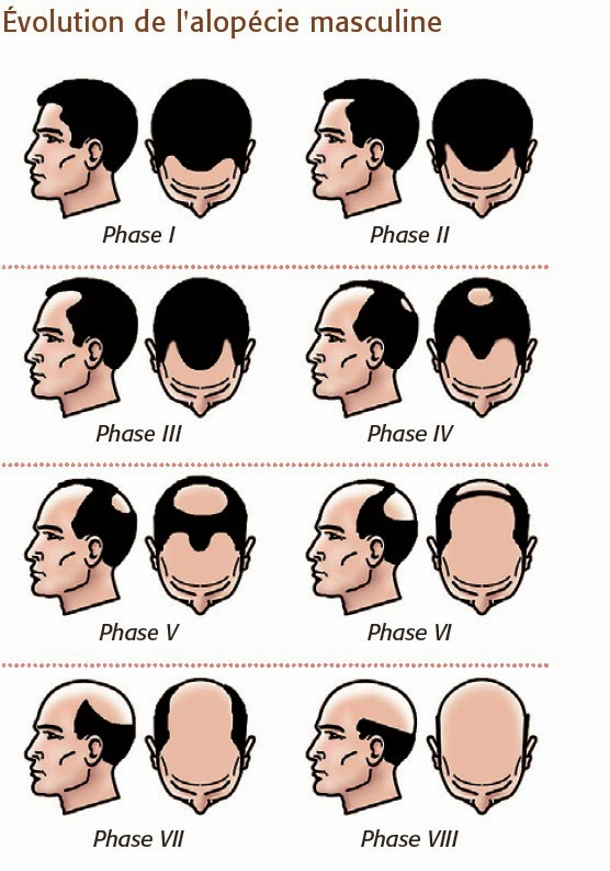 Alopecie chez l'homme