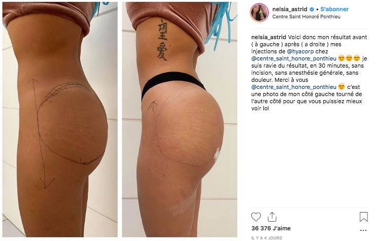 chirurgie-fesses-nelsia-Astrid-Instagram