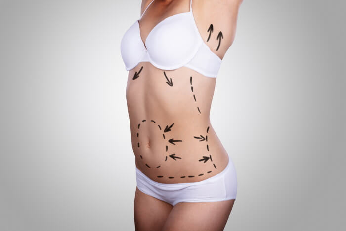 liposuccion Turquie