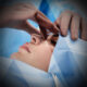 rhinoplastie de correction