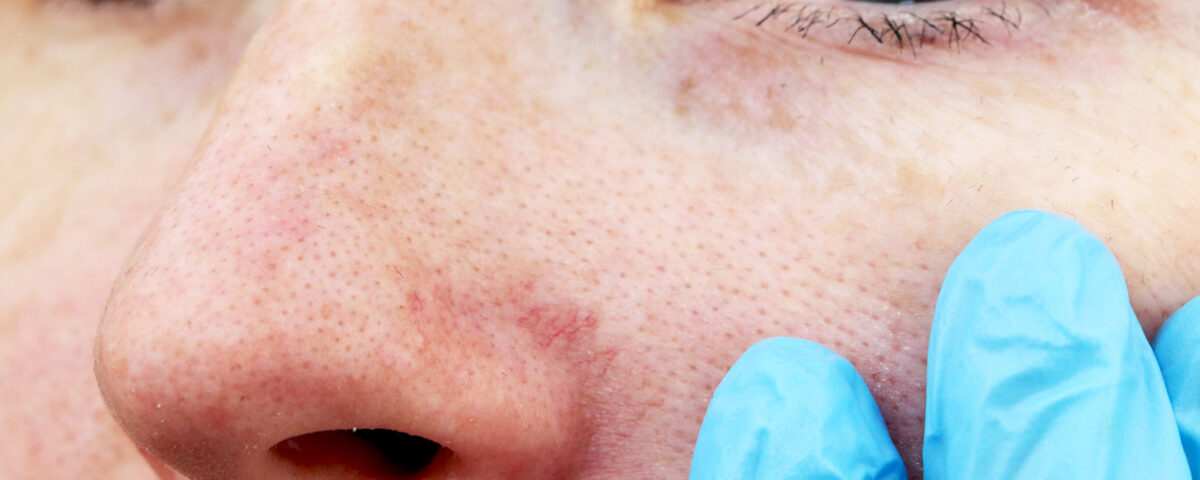 traitement pour les veines sur le nez