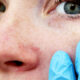 traitement pour les veines sur le nez