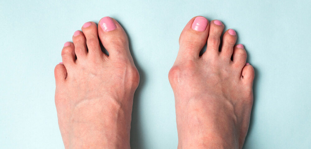 traitement-hallux-valgus
