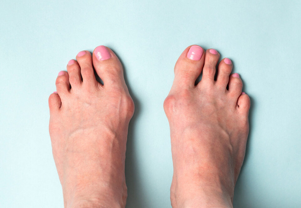 traitement-hallux-valgus
